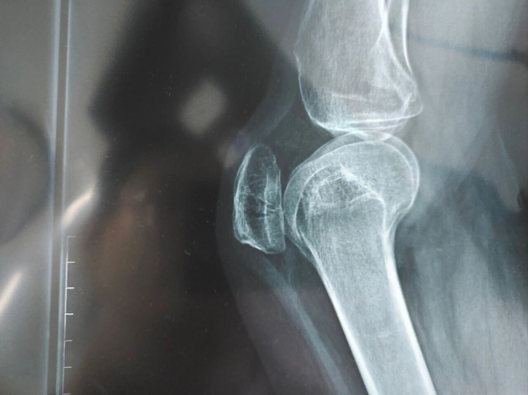 现在膝盖天天肿,都需要拄着拐了.