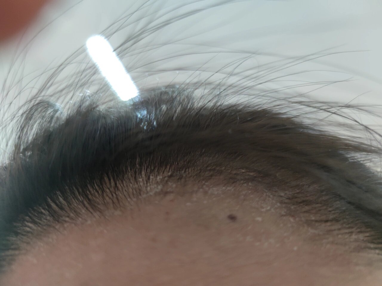 额头起皮 额头有头发根起皮,是干燥还是过敏?