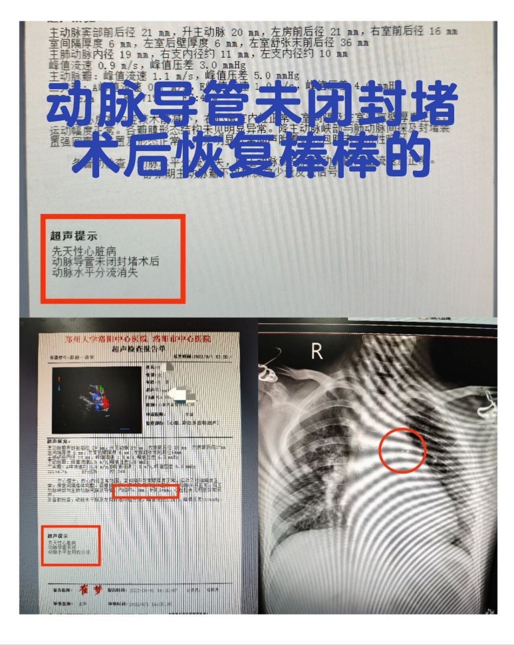 动脉导管未闭手术图片