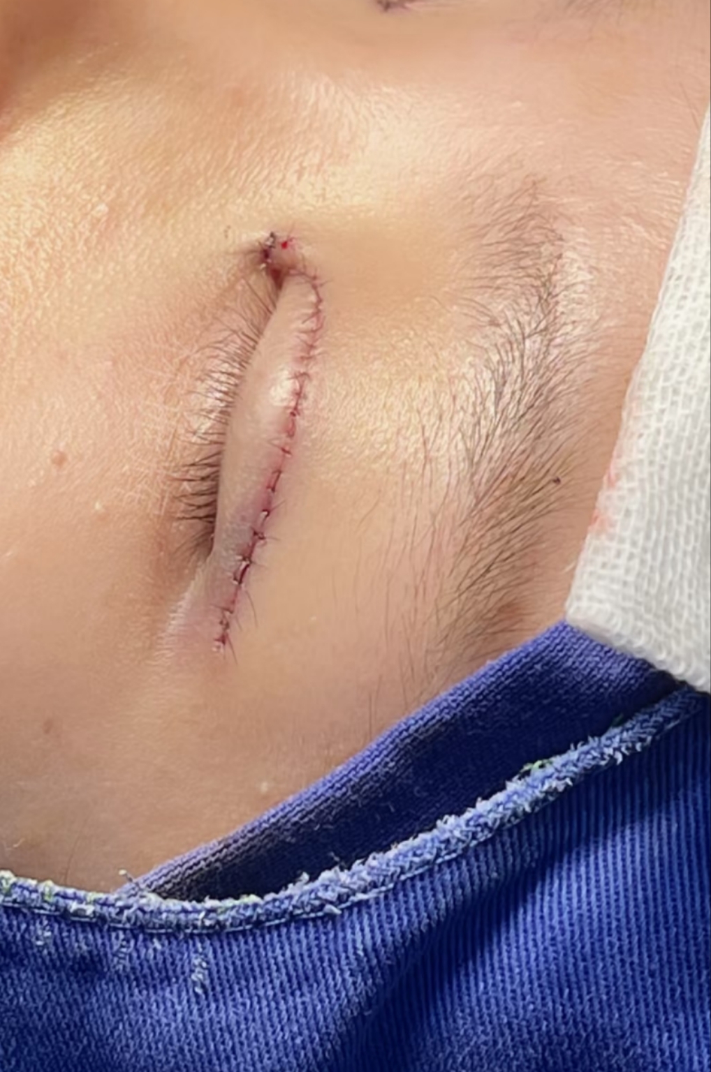 然后用专用工具在上眼睑做切口,去掉多余组织后缝合固定,这样就能形成