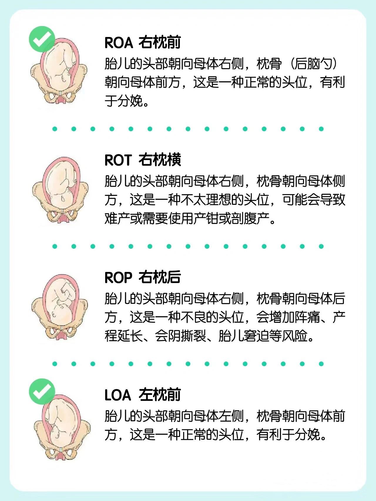 胎位rot可以顺产吗图片