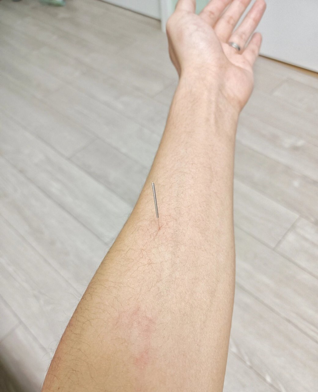 自学针灸 - 孔最穴 这个很好扎,位置找对了就可以.
