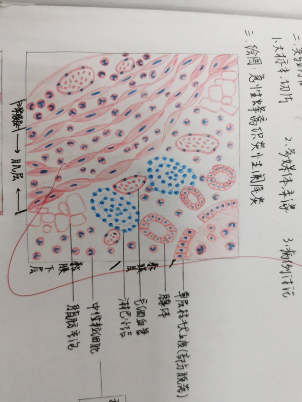 阑尾蜂窝织炎手绘图图片