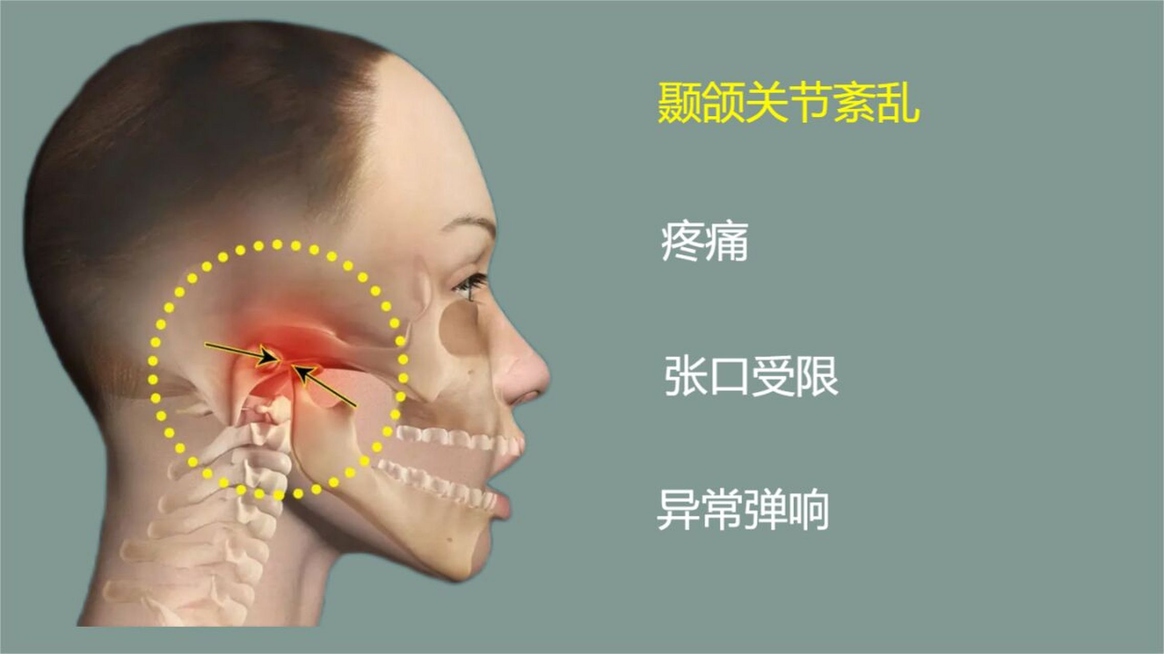 颞颌关节紊乱的中医治疗效案分享 最近一段时间接诊了好几例颞颌关节