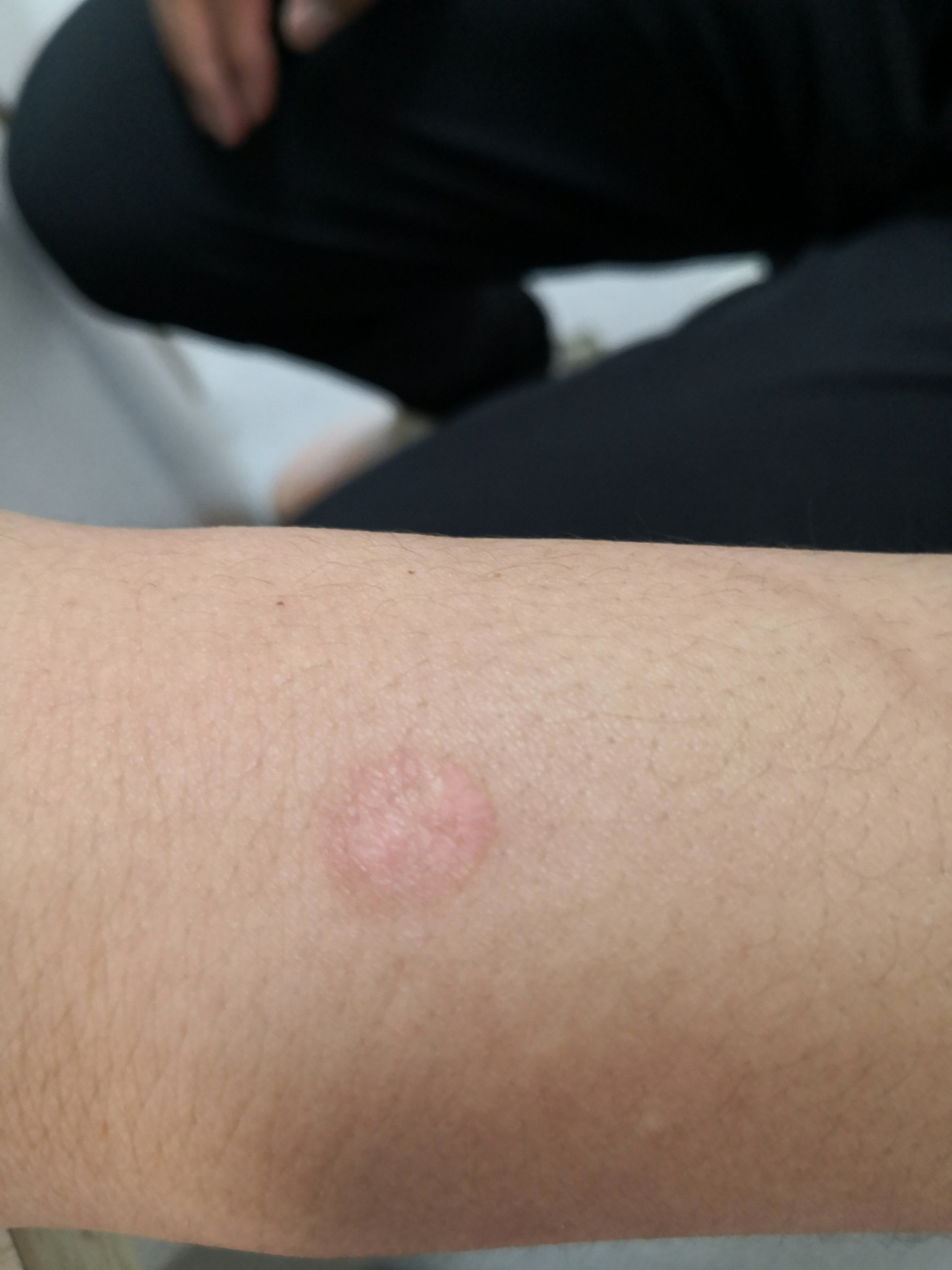 病毒##解决皮肤问题专注皮肤美容##扁平疣