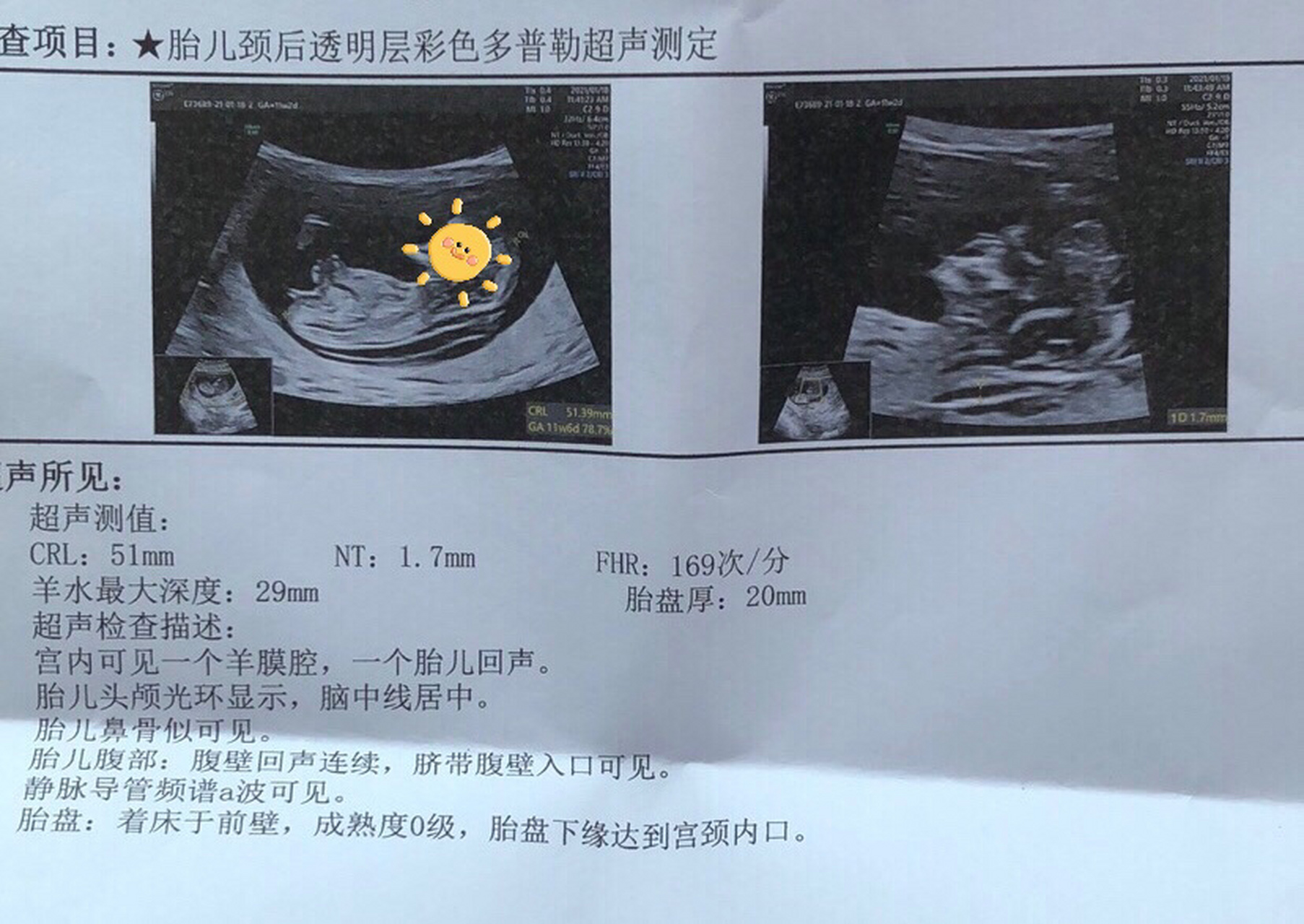 12周nt过,不知道是男宝宝还是女宝宝,爱你