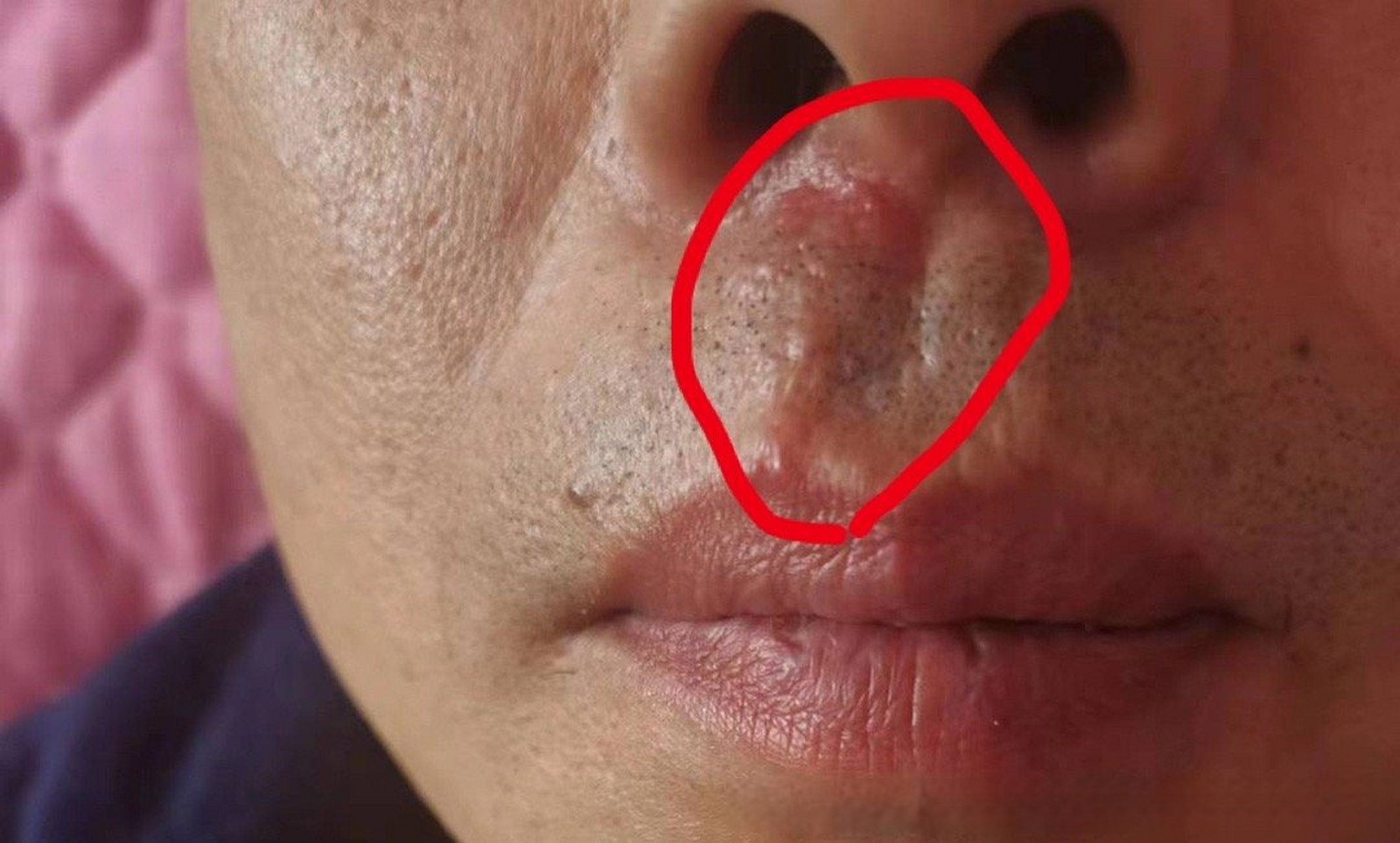 健康科普# 口唇单纯疱疹一般是由单纯疱疹病毒一型感染以后导致的