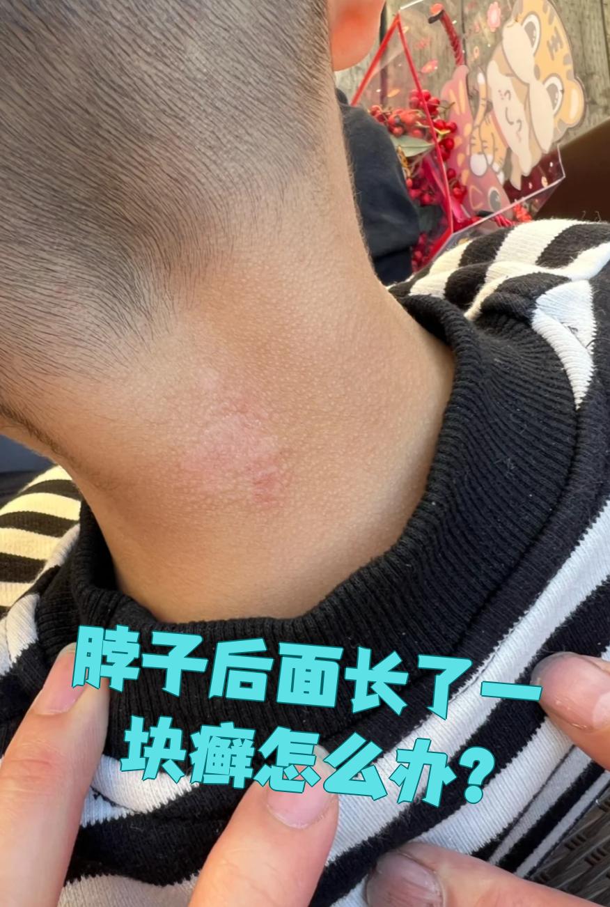 如果是接触性皮炎,通常因为皮肤接触到花粉,尘螨等过敏原,会出现
