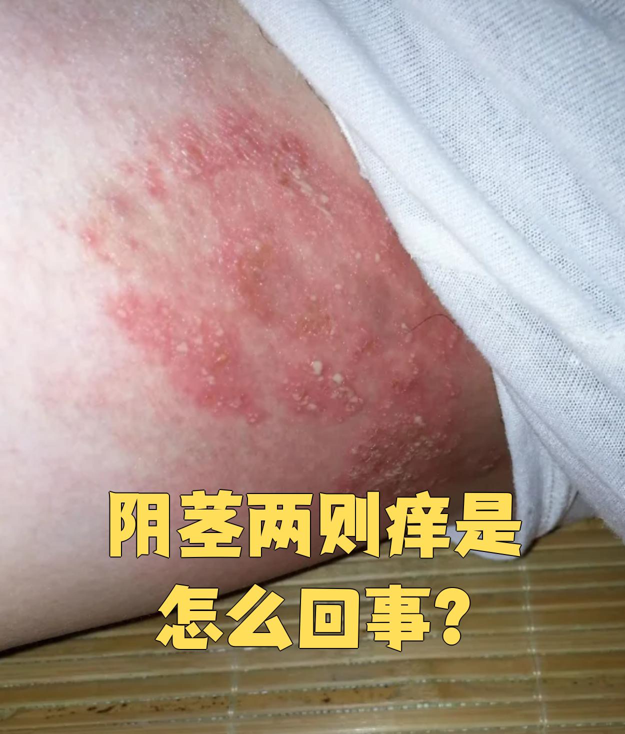 阴茎两侧发痒常见的原因有包皮龟头炎,股癣和阴囊湿疹,具体表现和