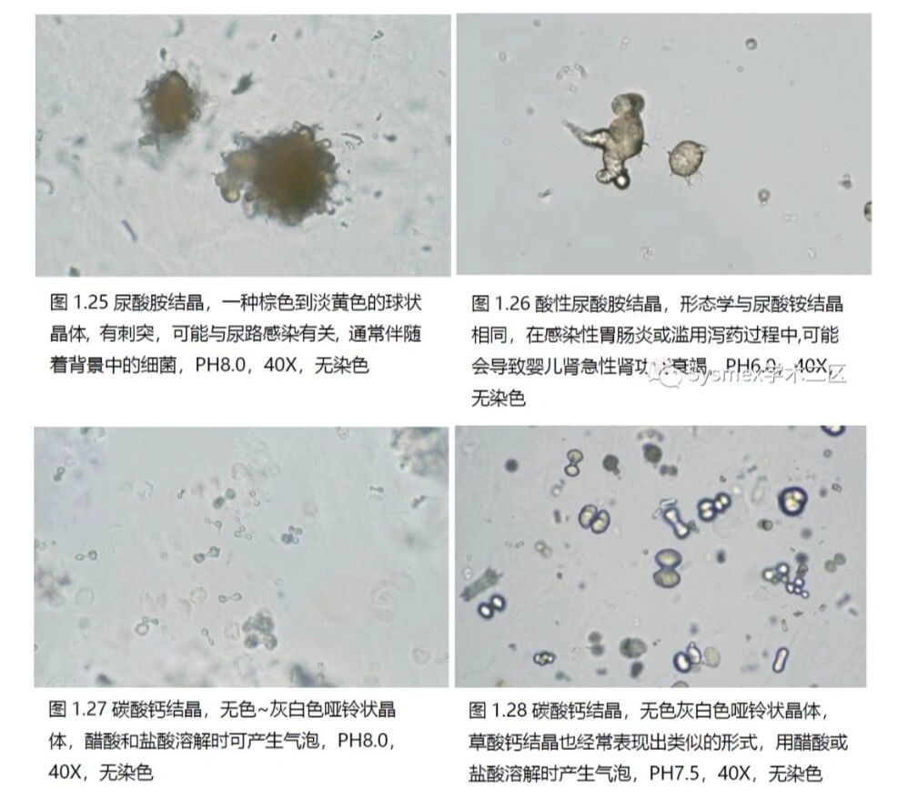 尿液中的结晶图片