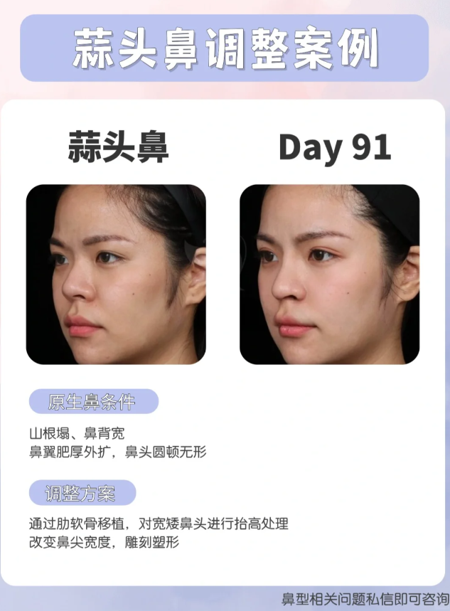 【原生鼻条件】 山根塌,鼻背宽 鼻翼肥厚外扩,鼻头圆顿无形 【调整