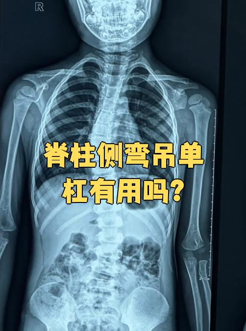 吊单杠对脊柱侧弯确实有帮助