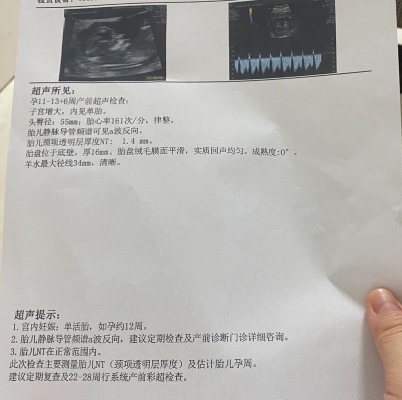 静脉导管反向 去不同医院拍了两次都说是静脉导管a波反向.