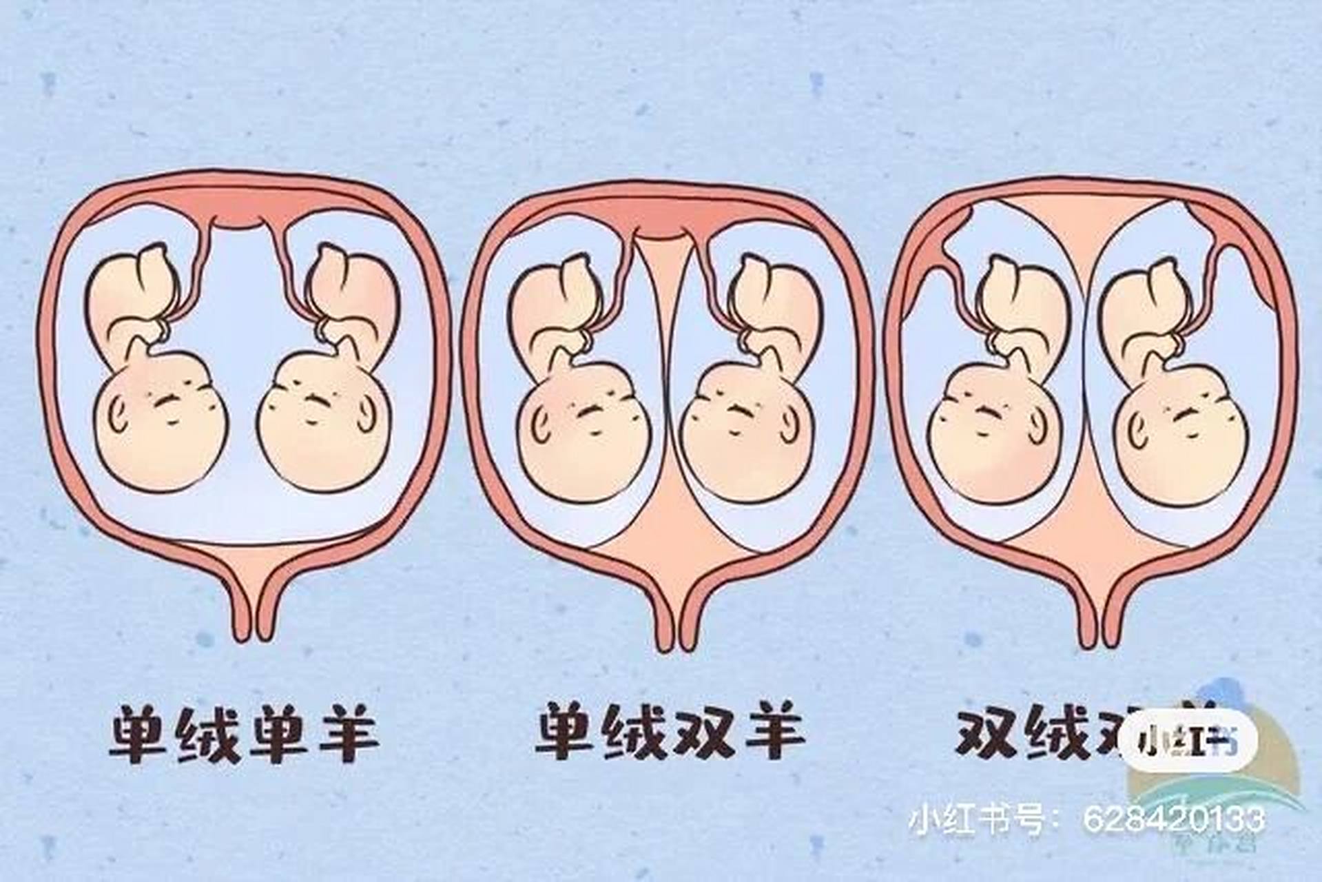 单绒单羊双胞胎 六周去做b超,检测出来是单胎.