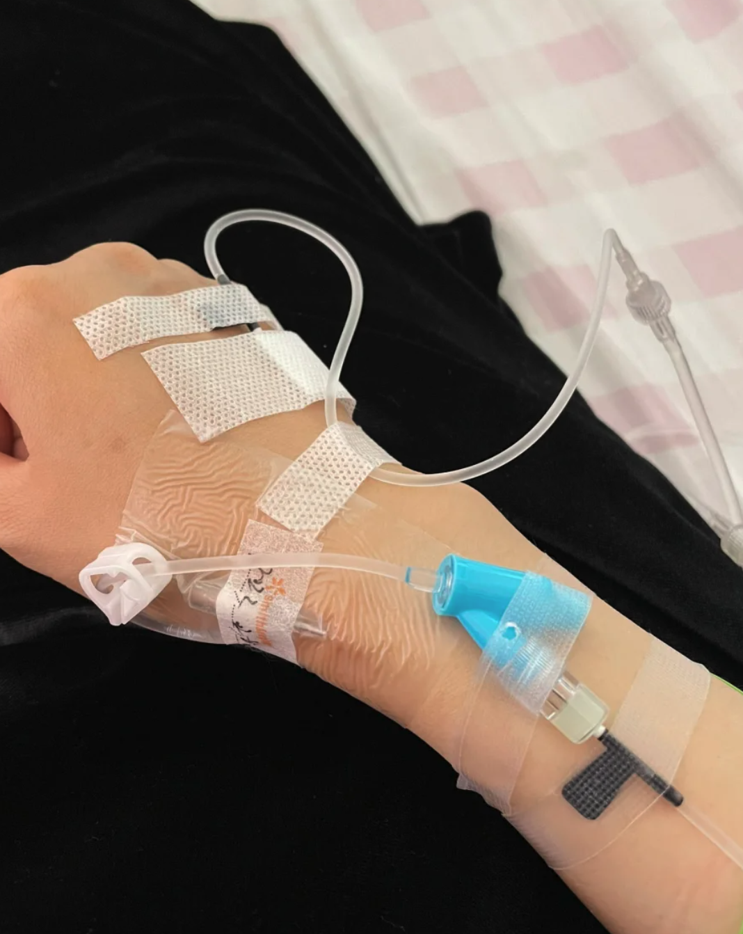 留置针也叫套管针,主要分两部分:一根能留在血管里的软管,还有一根