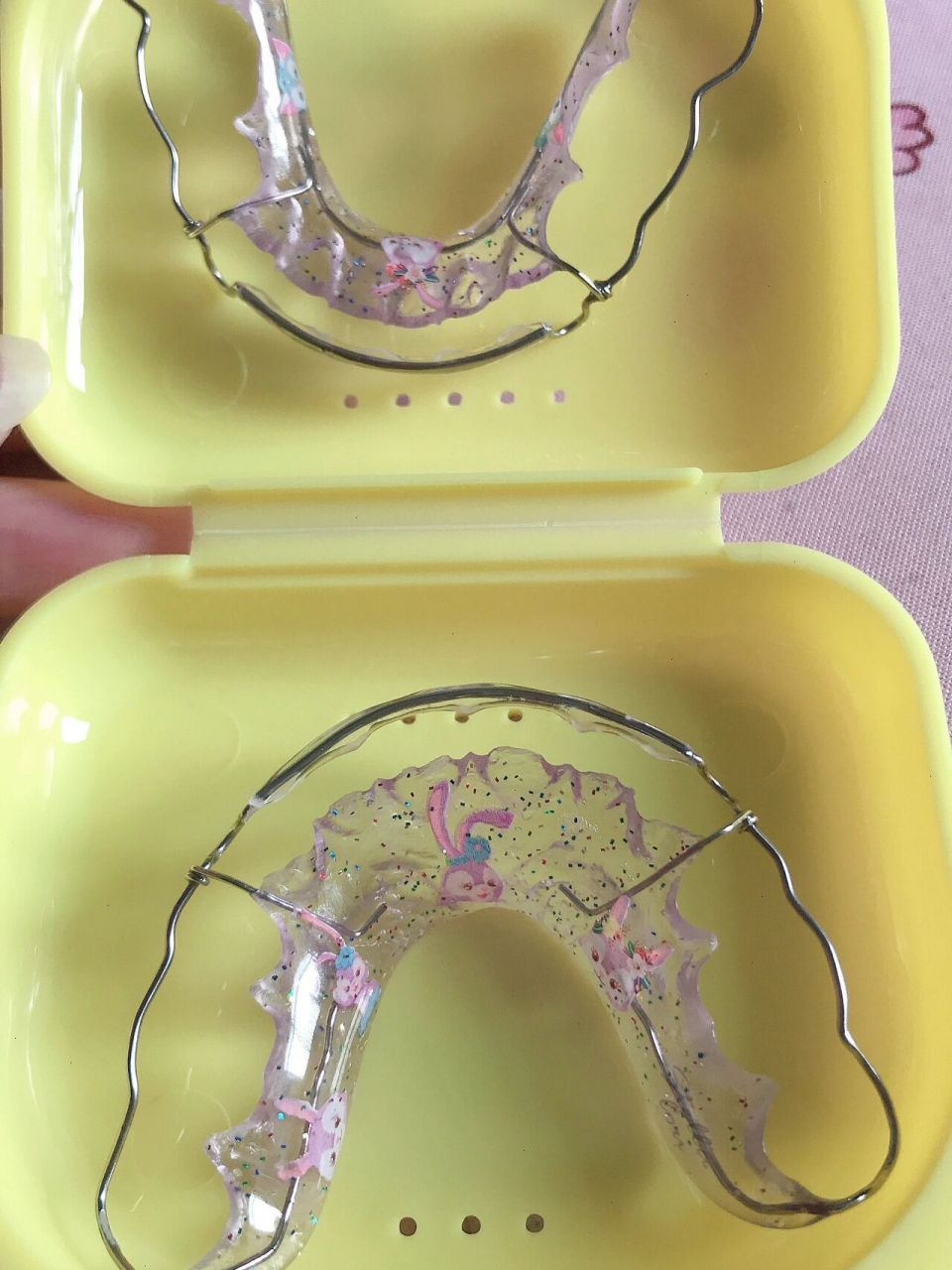 比格保持器 保持器 新年给自己换了一副保持器,99宝定制300,实体店