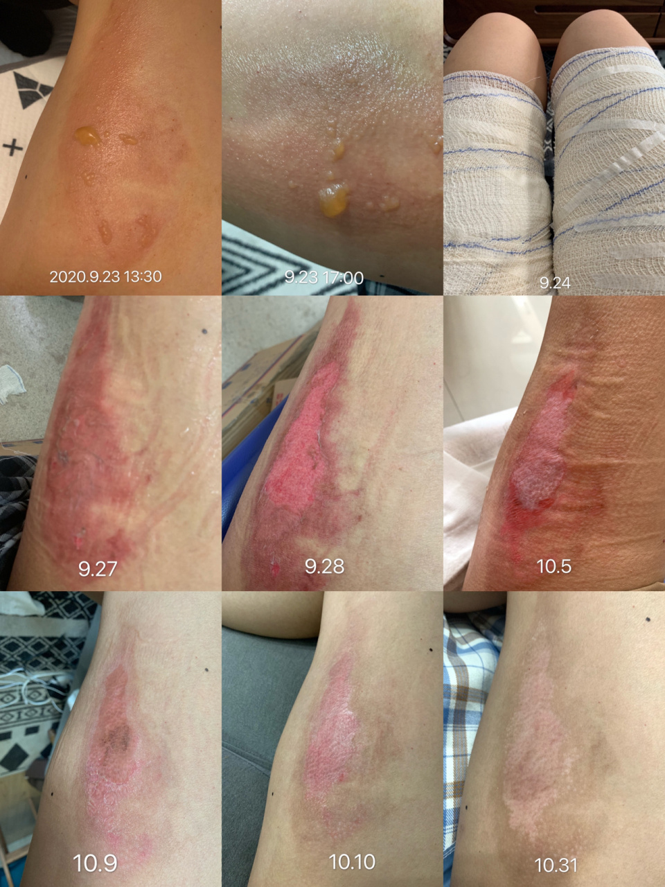 腿部二度烫伤经历 早上起床烧开水倒入杯子中,不小心碰倒杯子烫到大腿