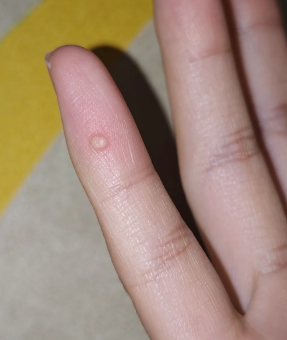 手上起小疙瘩但不疼不痒,可能是手癣或寻常疣引起的