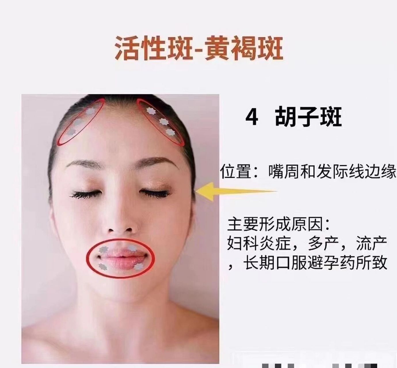 活性斑---黄褐斑--4.胡子斑