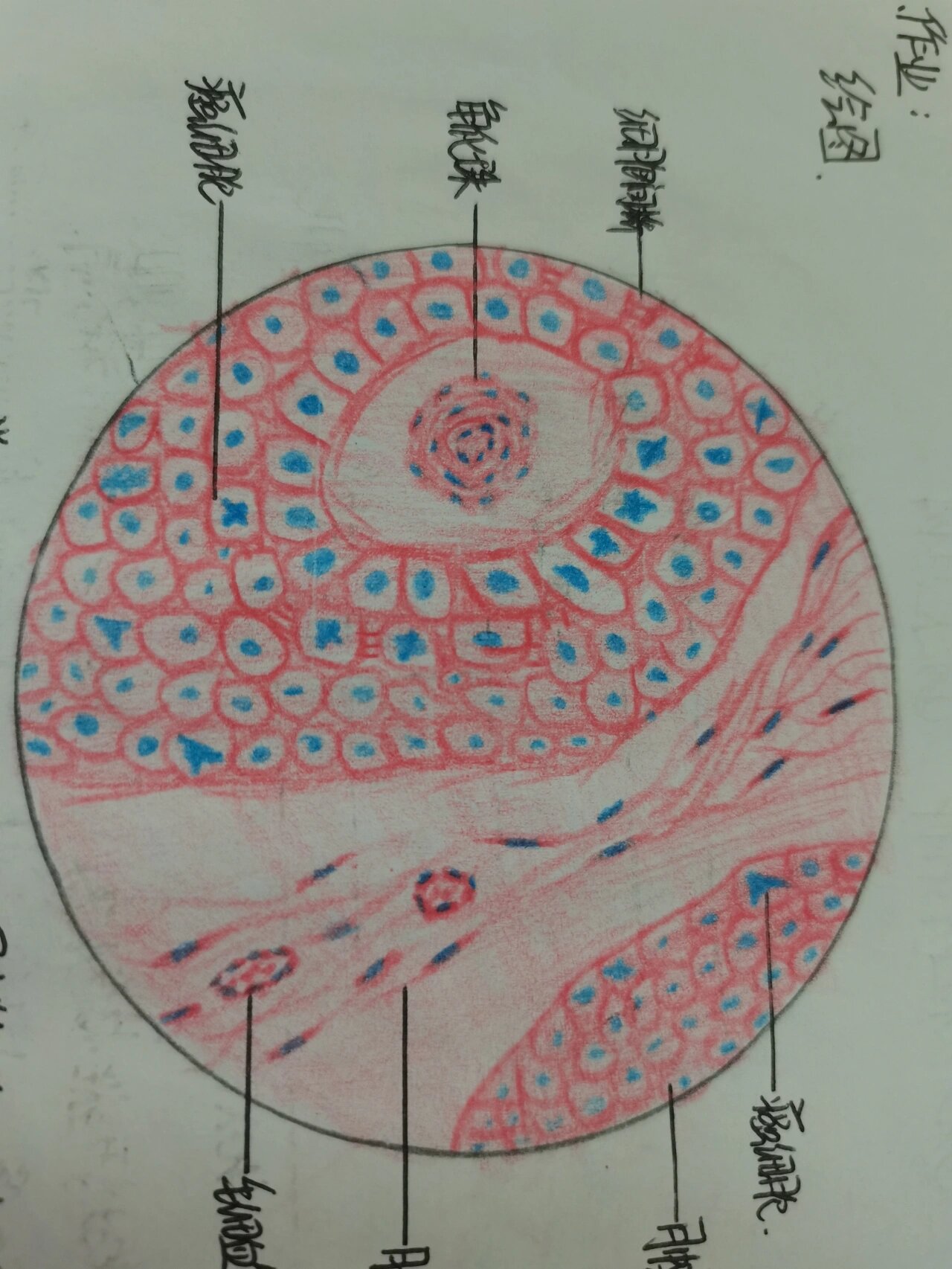 病理切片-高分化鳞癌 诊断描述: 低倍镜下,肿瘤实质与间质分界清晰.