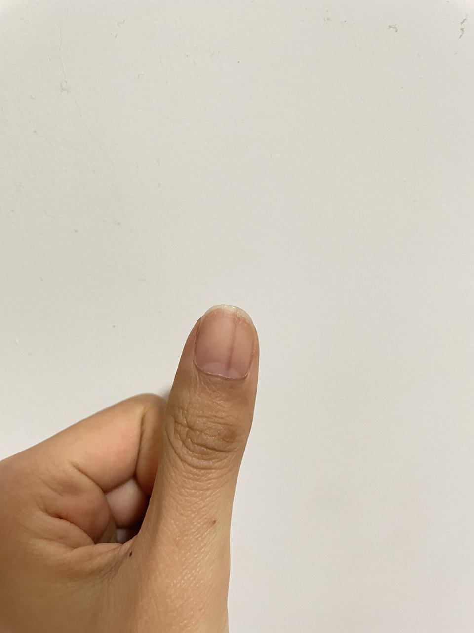 大拇指黑线癌症前兆图片