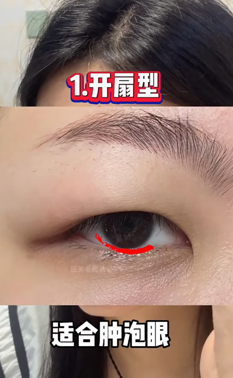 开扇双眼皮:双眼皮线从内眼角开始逐渐加宽,形似扇子的形状,自然而