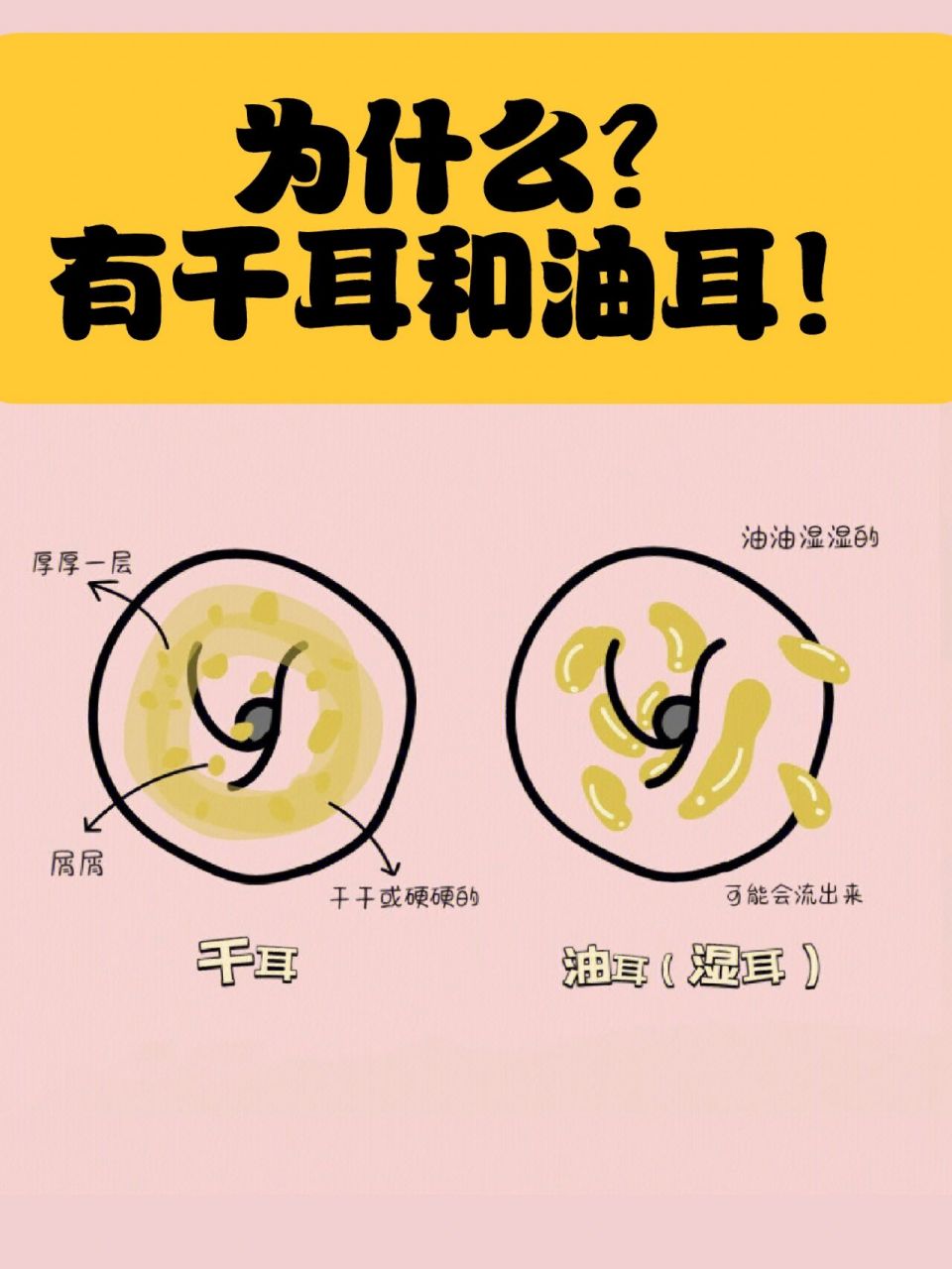 9090 78什么是油耳71 所谓的油耳朵,是说耳朵中的油脂腺分泌