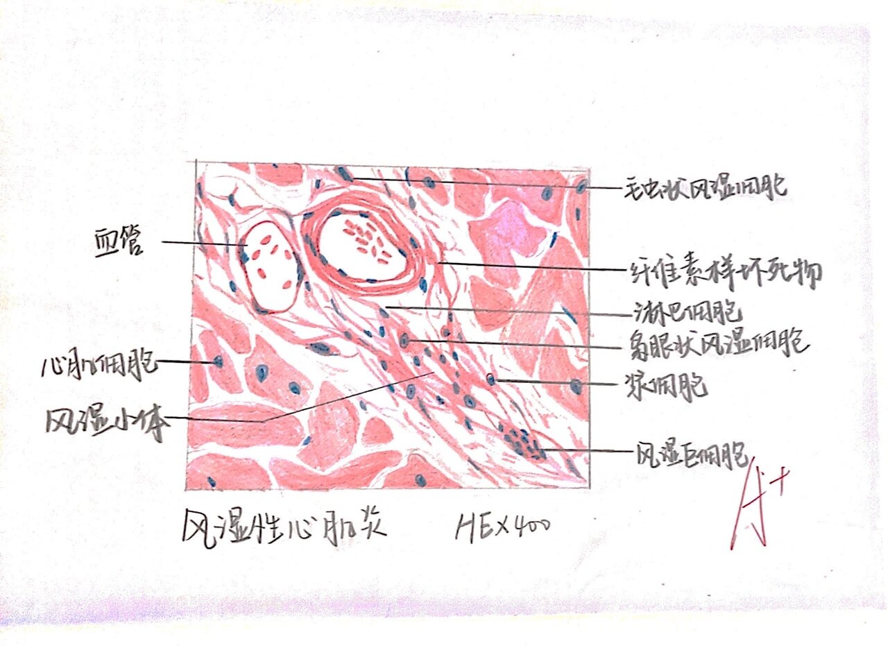 病理红蓝铅笔绘图(2) p1风湿性心肌炎 p2动脉粥样硬化 p3大叶性肺炎