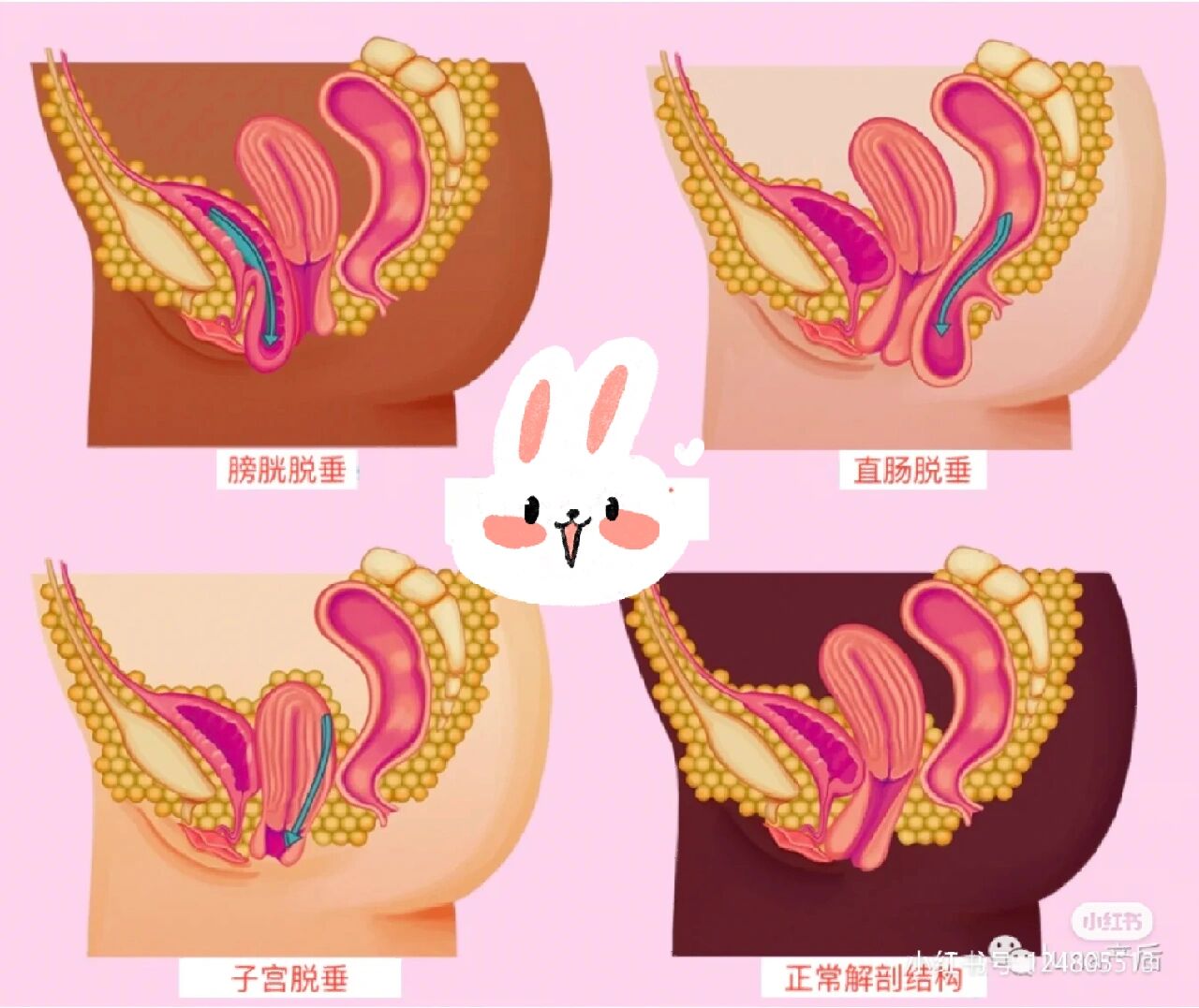 产后阴道膨出的评估