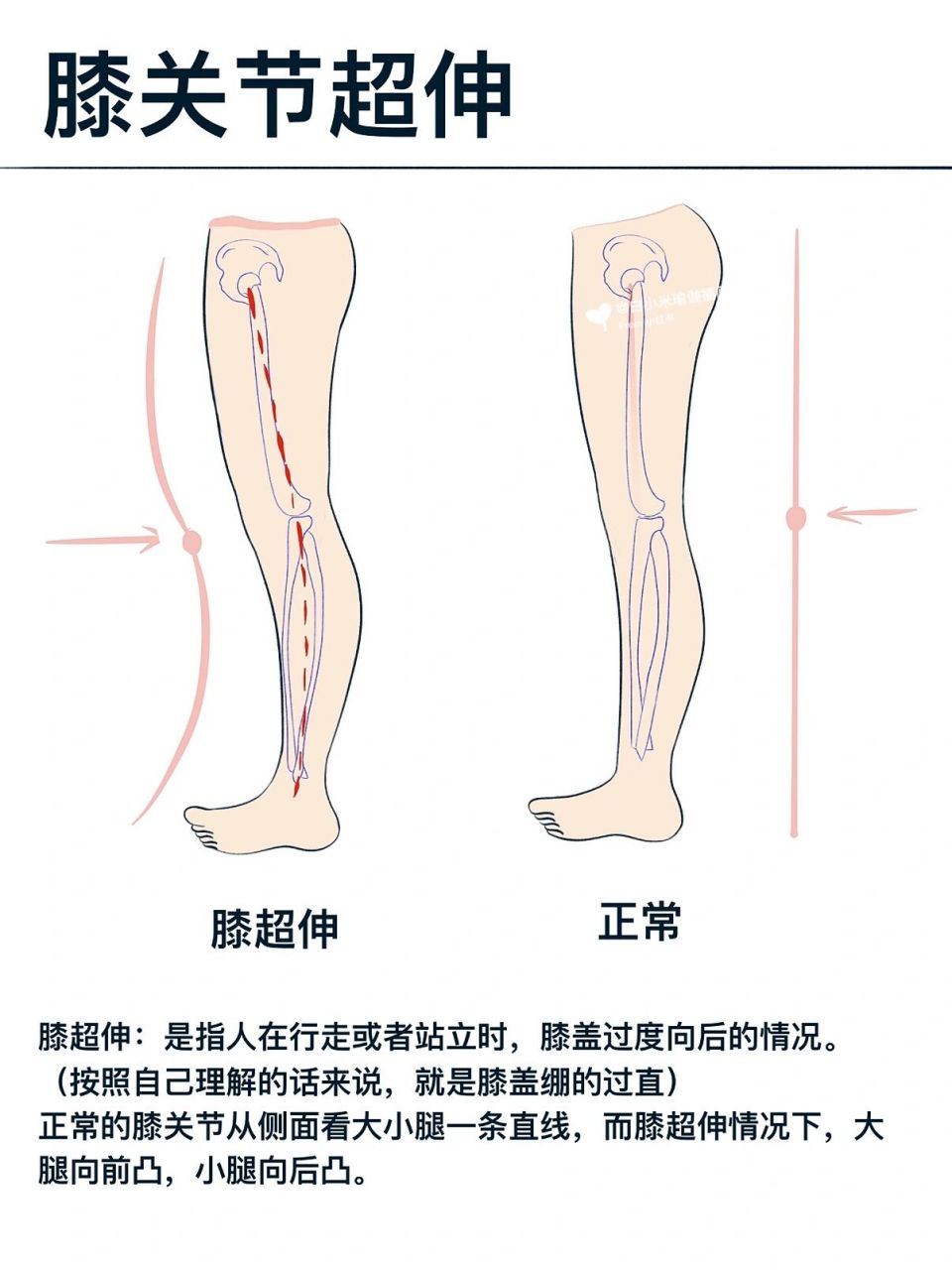 膝超伸怎么改善图片