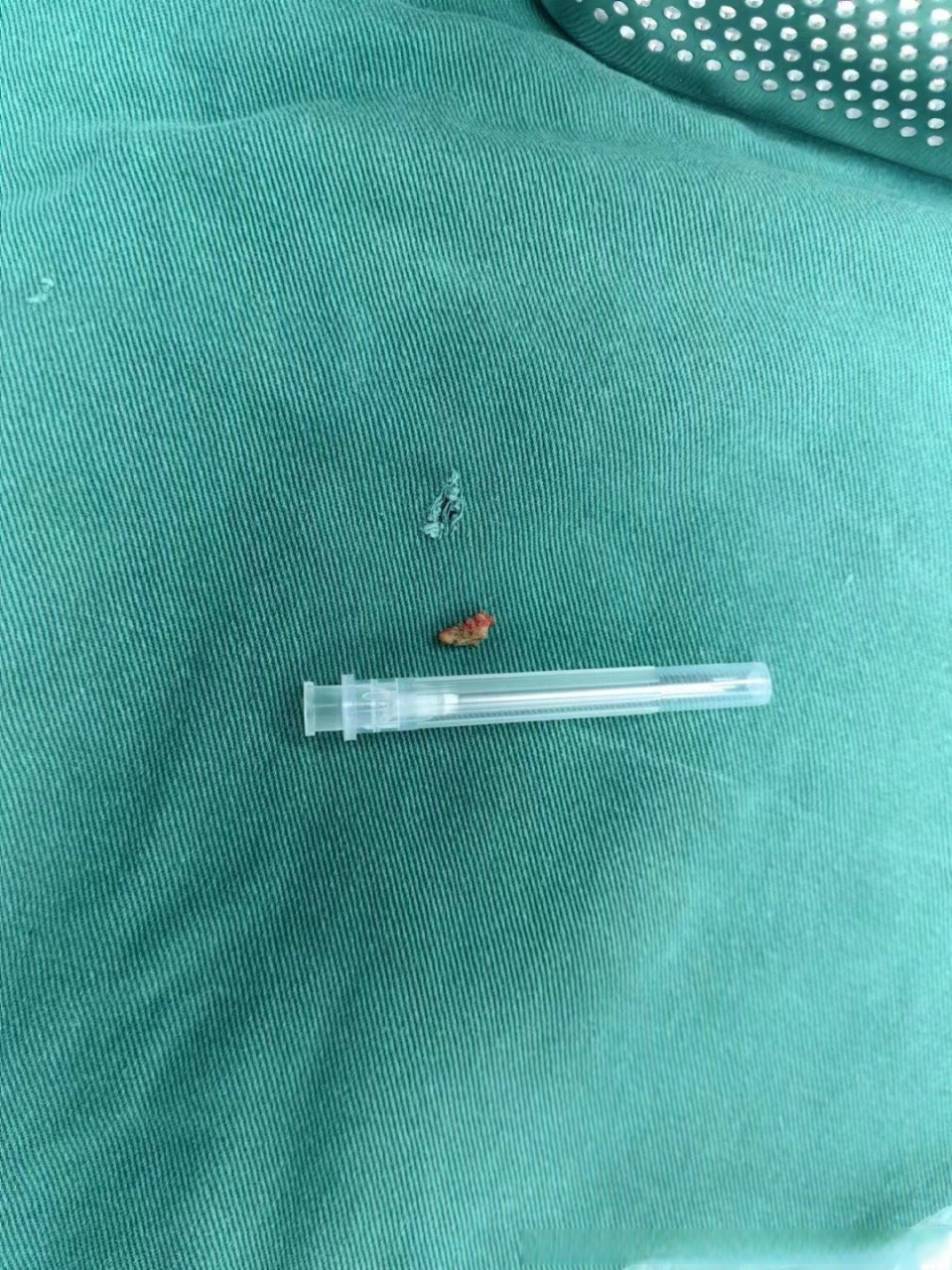 今日典型病历:输尿管上段结石,虽然宽度不大,但是长度比较长,且结石