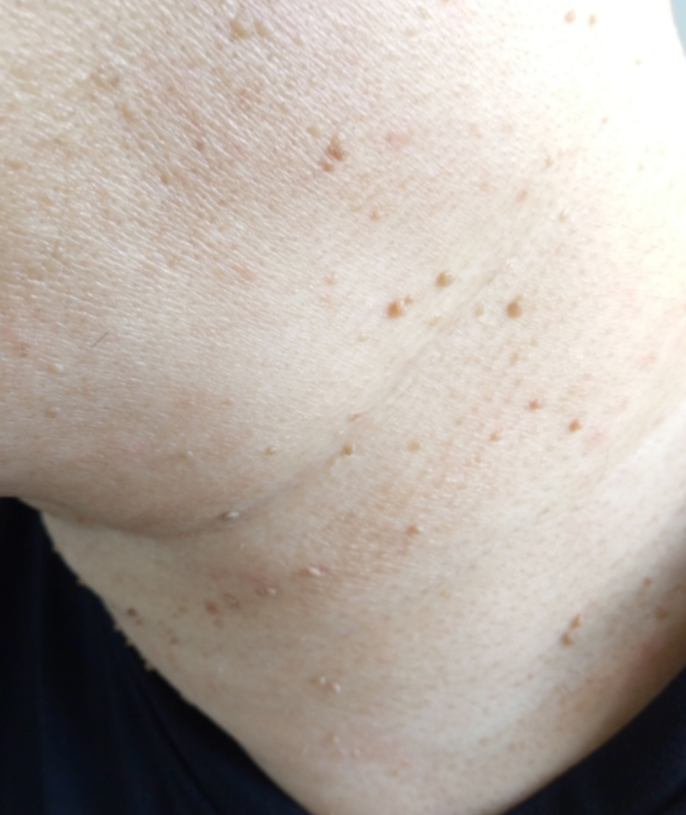 脖子上长小肉粒可能是人乳头状病毒感染引起的,也可能是毛囊炎或