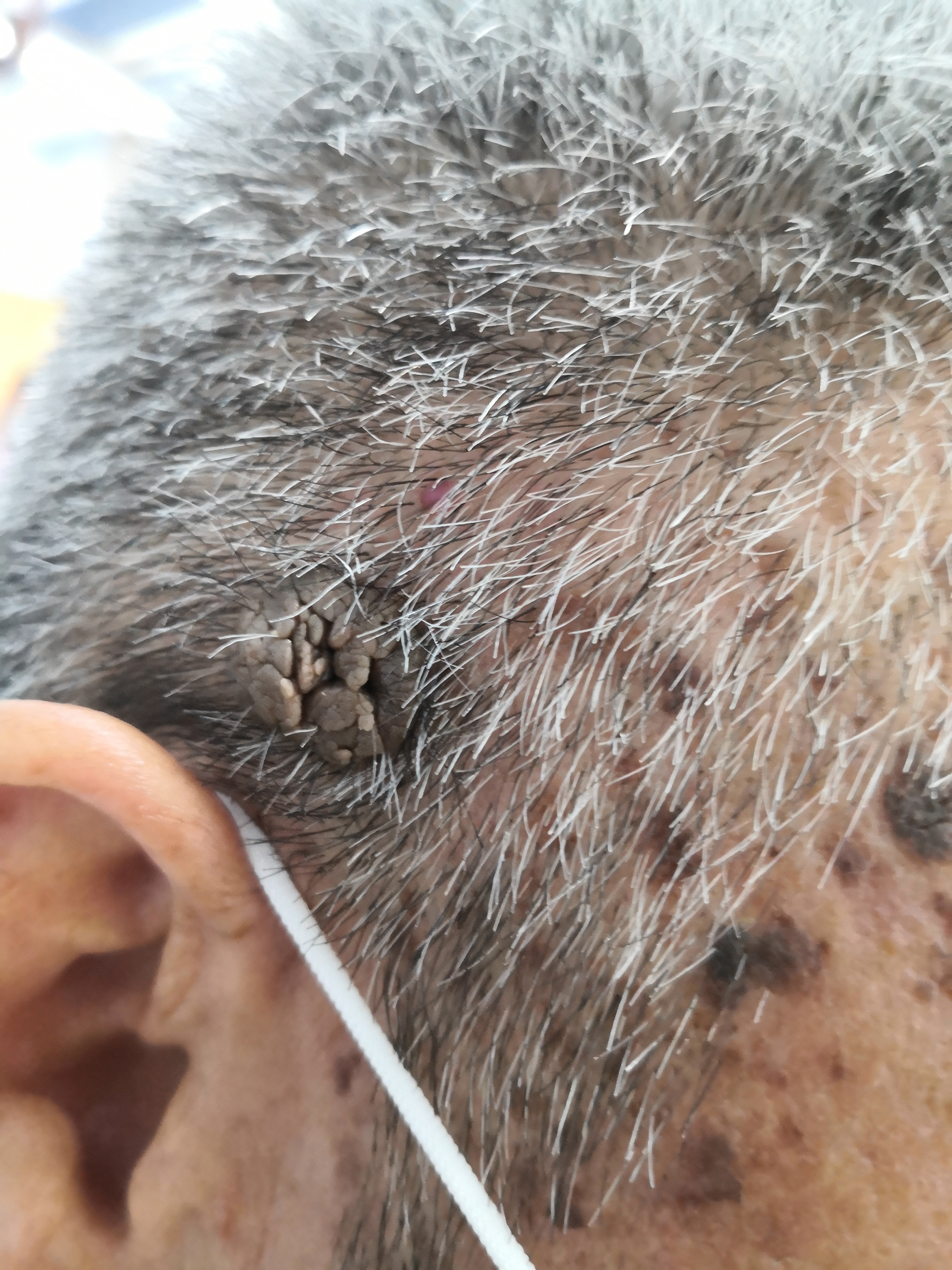 头皮疣状物激光治疗去.@纪秀军皮肤科主任医师的动态