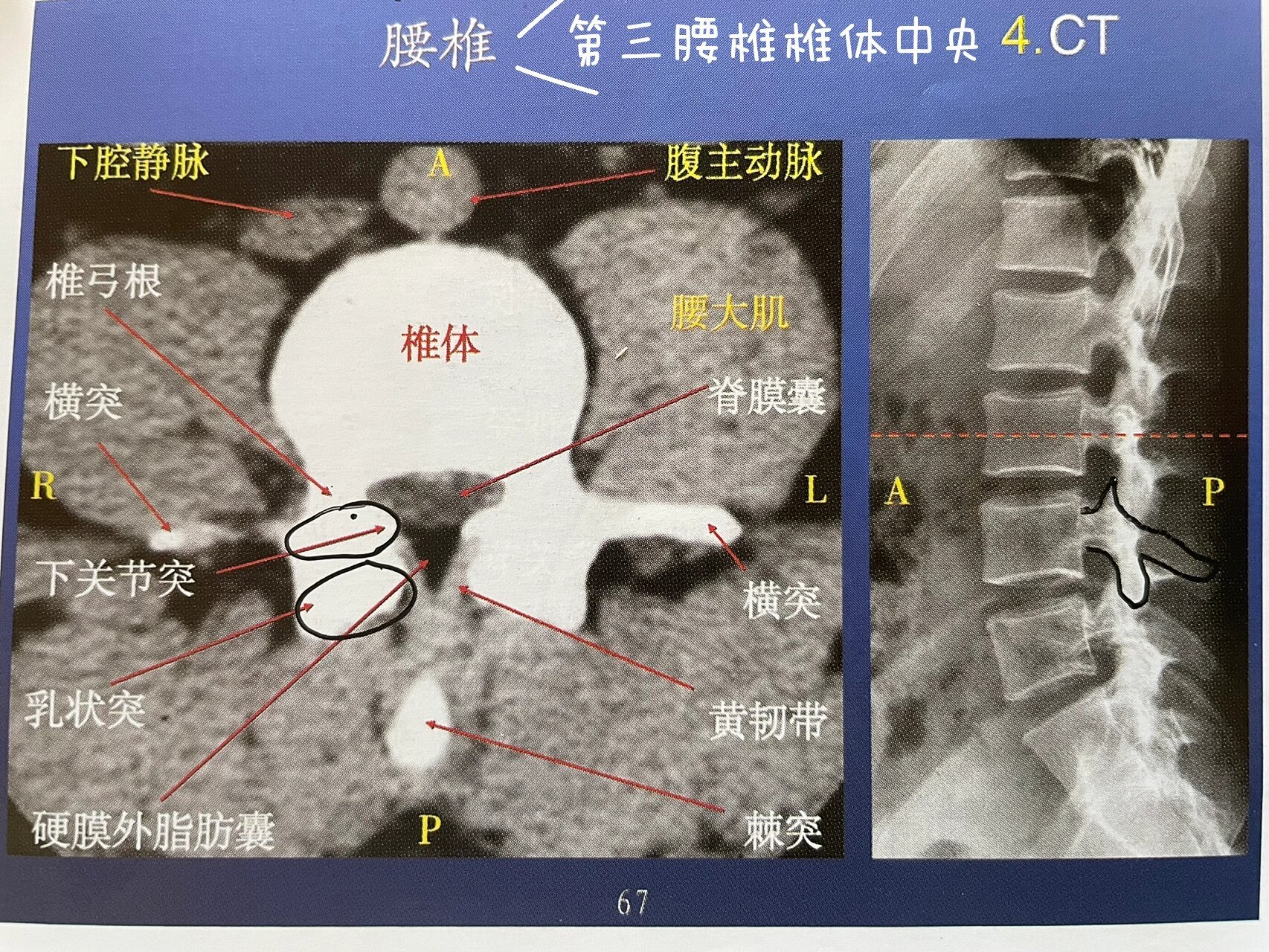 腰椎椎体ct断层解剖图图片