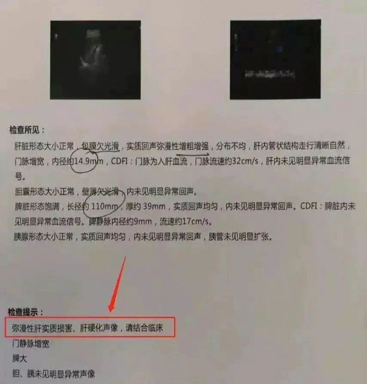 门静脉宽度:门静脉大于1.3cm可能有肝硬化的