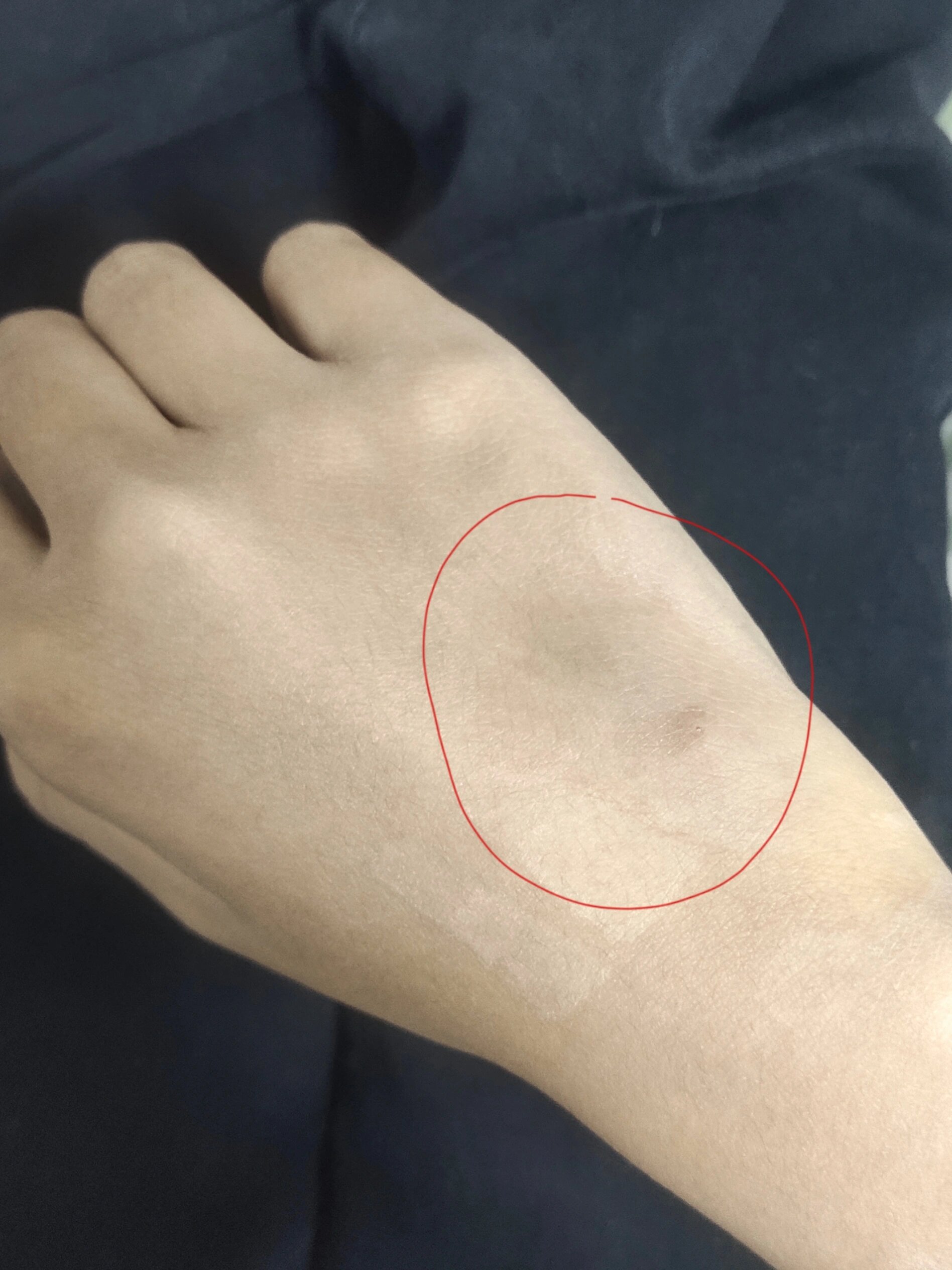 输液回家手肿了个大包