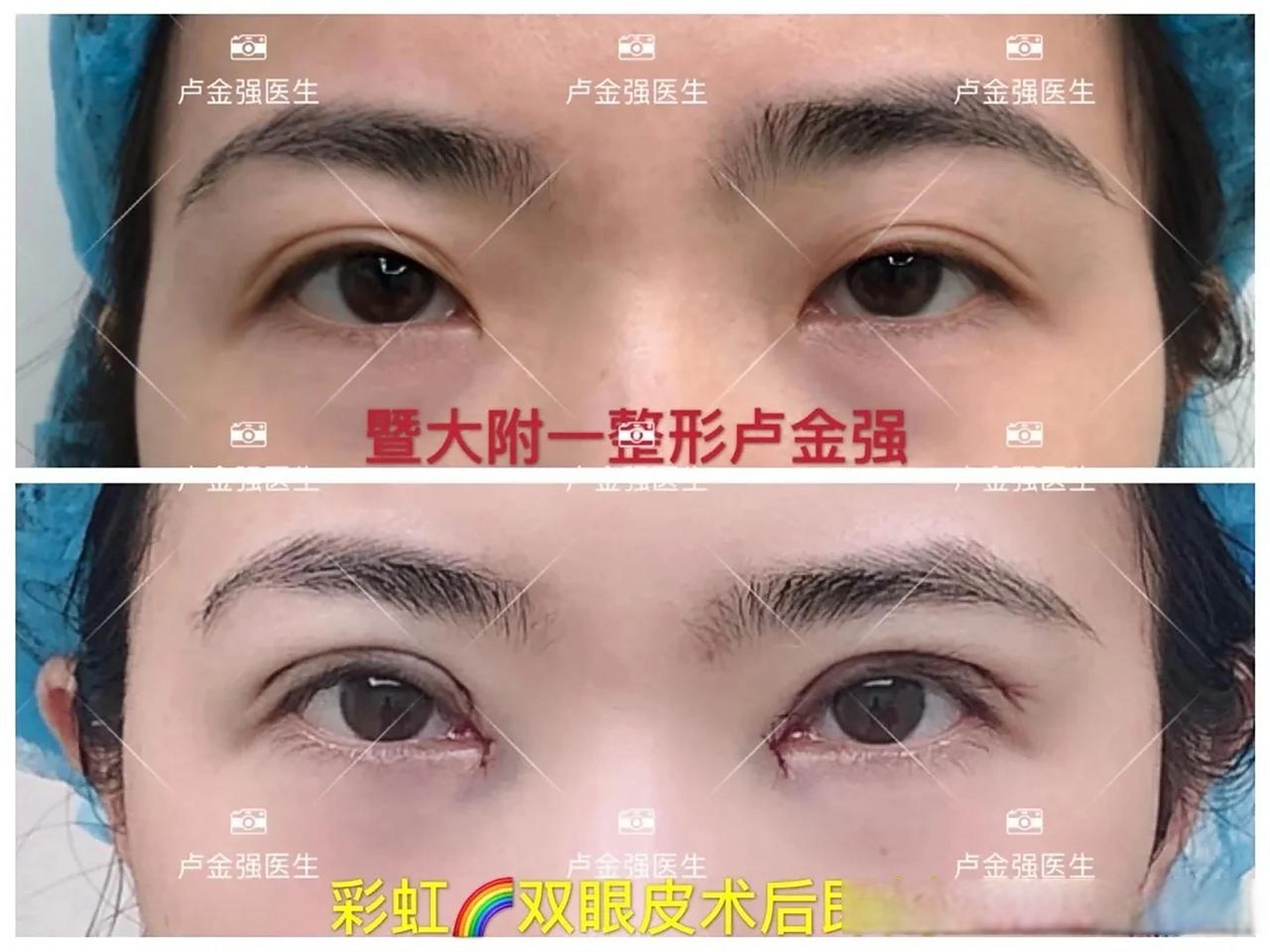 【双眼皮修复案例】 姑娘以前做过双眼皮 提肌手术,现在两眼还是挺不