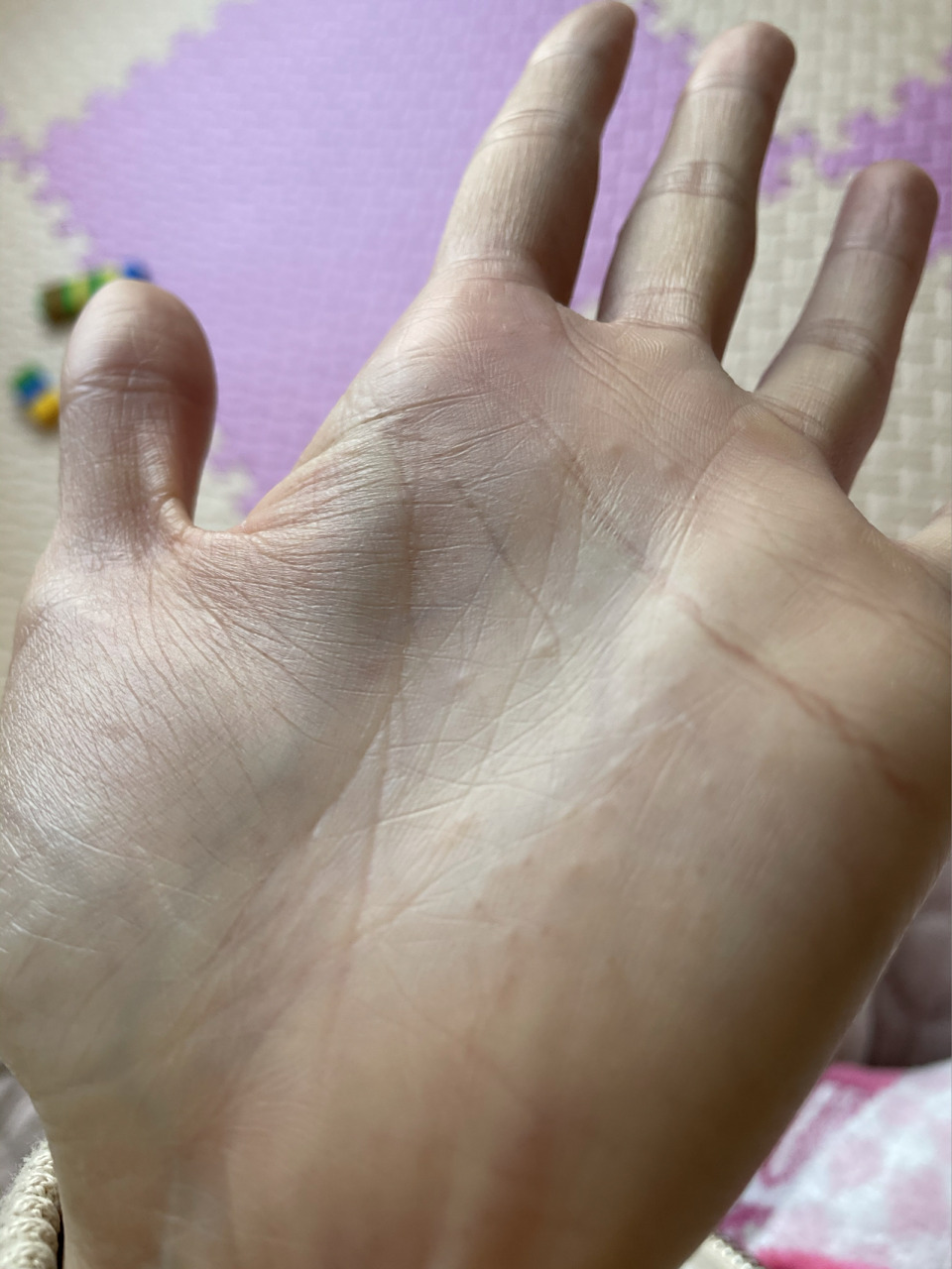 手掌上长了很多小疙瘩是怎么回事?求助! 突然发现的,求解!