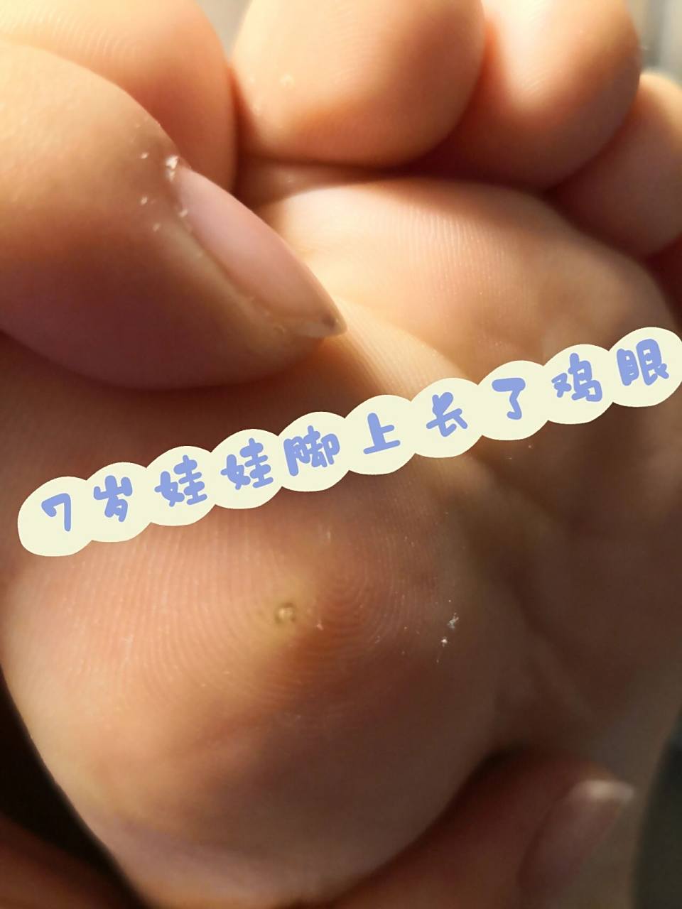 七岁娃脚上鸡眼治疗一周痊愈 luna突然早上说脚疼,昨天还欢蹦乱跳