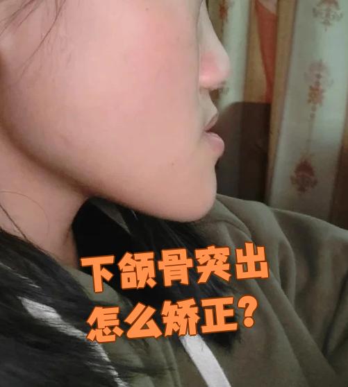 下颌骨突出主要是因为上颌发育不足导致上颌短小后缩,同时下颌过度