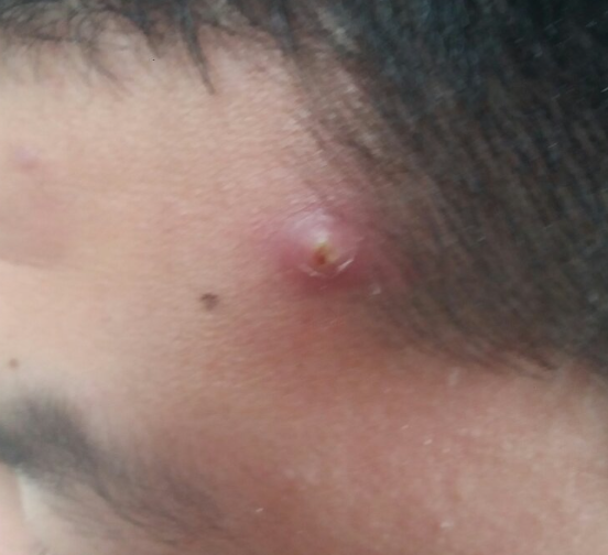 鬓角两边长痘痘常见原因有痤疮,湿疹,过敏性皮肤病,毛囊炎和脂溢性