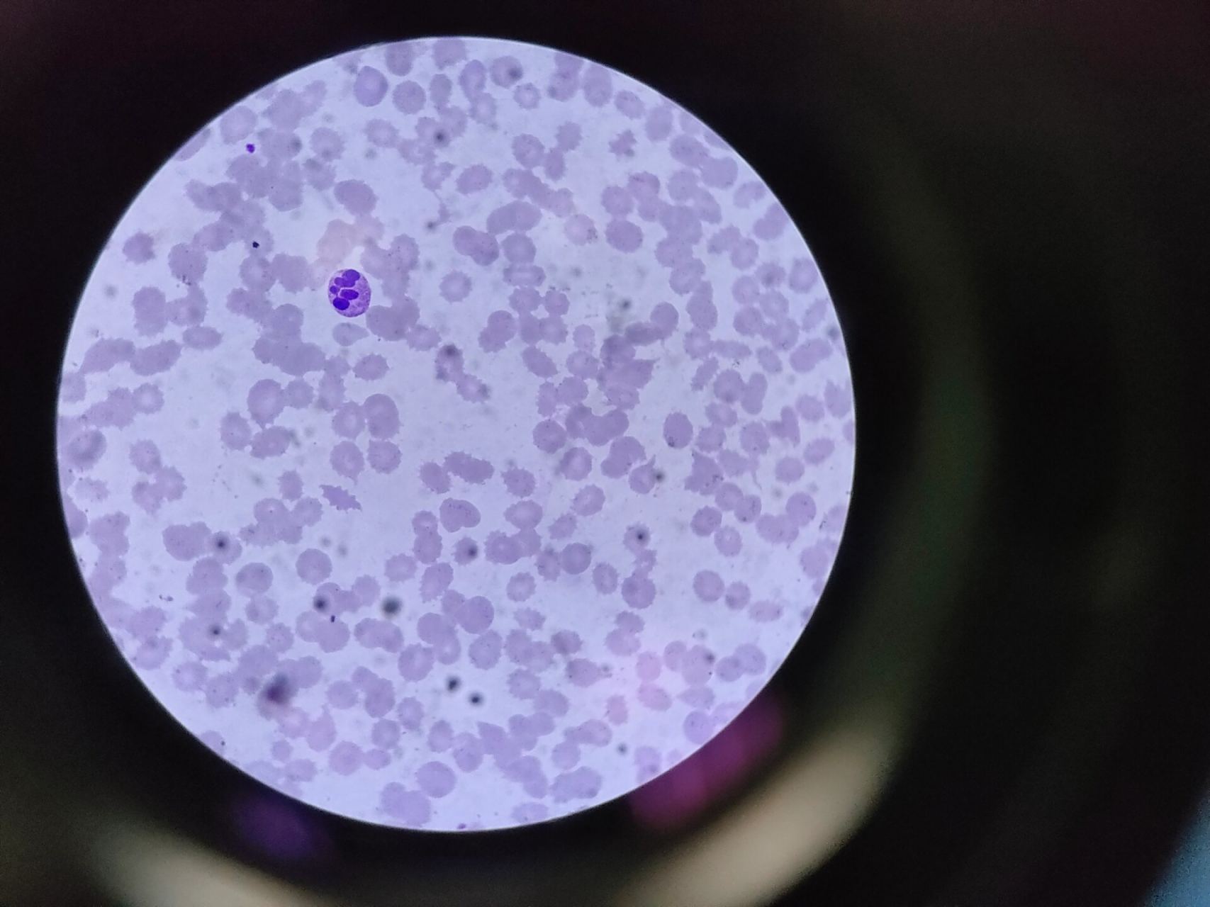 图二:红细胞形态异常,可见红细胞碎片