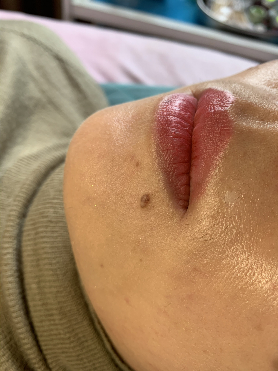 肉痣… 肉痣其61指实69的是一种61素色69痣,是61细痣69胞