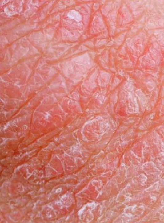 阴囊出现白色干燥脱皮,常见原因是阴囊湿疹或真菌感染,治疗方法要