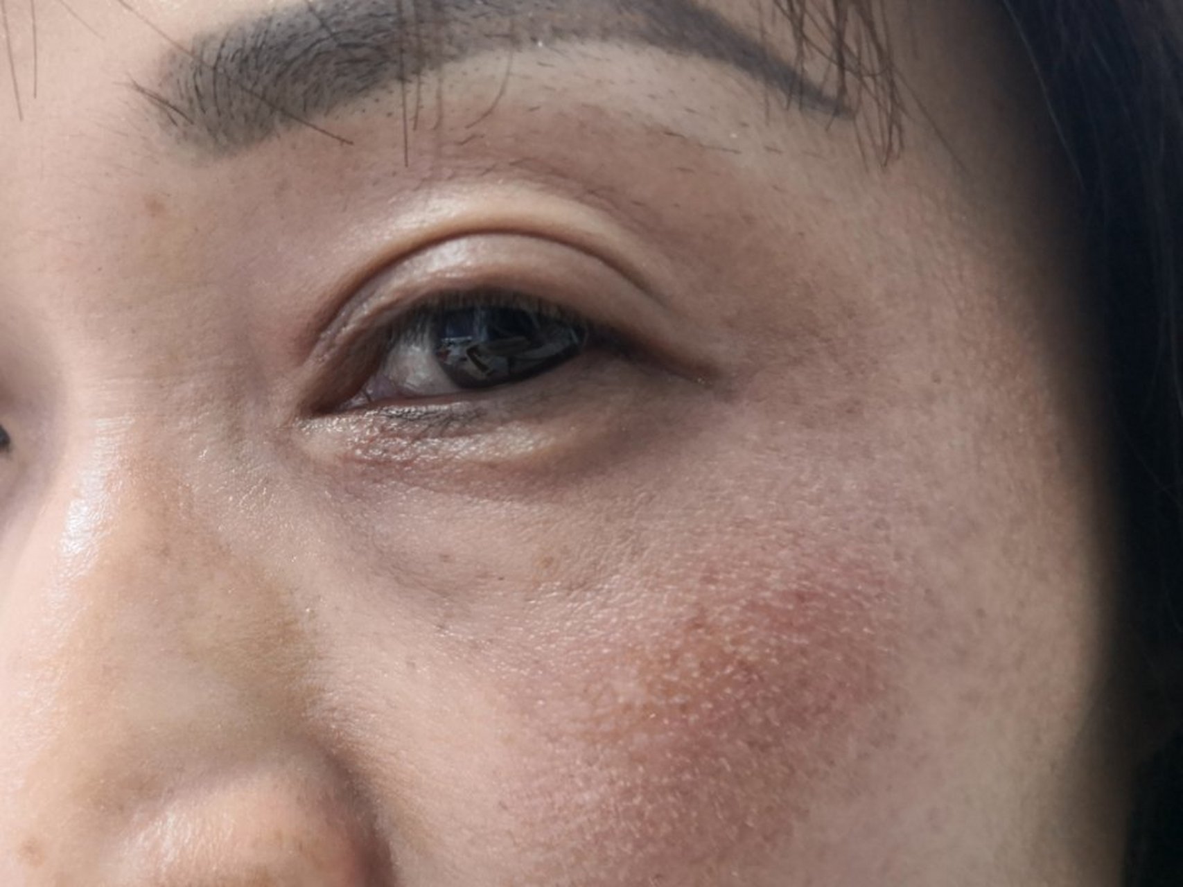 面颊颧骨部位和鼻梁根部两侧的黄褐色斑片.