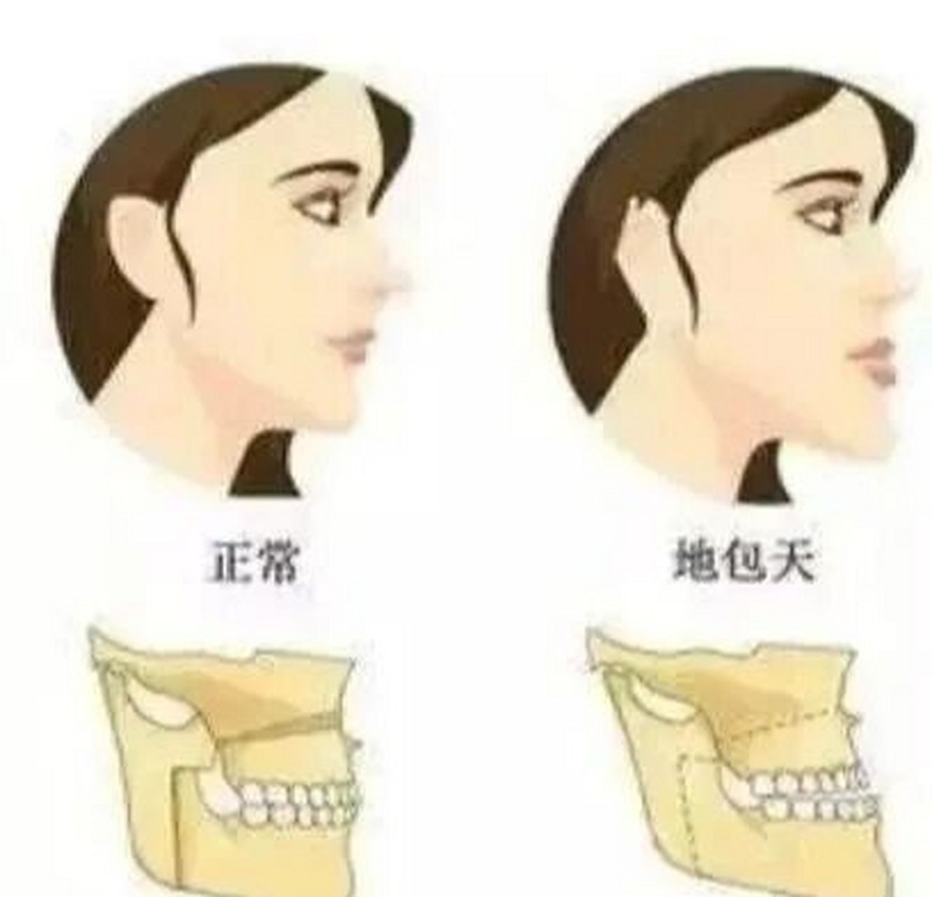 反颌出现时间不一致,多数在青春期,也有的三四岁就能看出来了,地包天