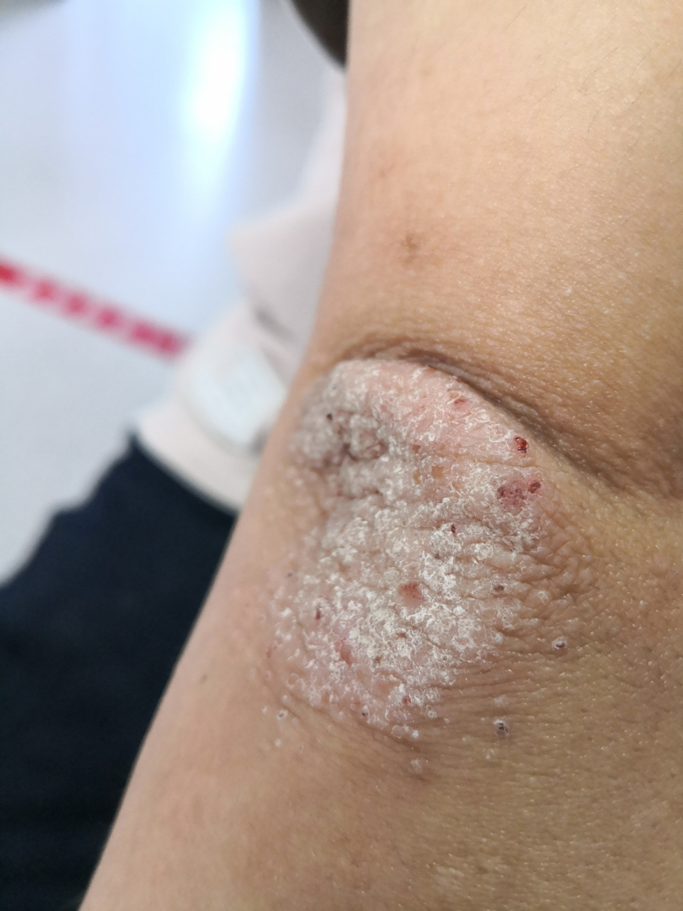 考虑神经性皮炎/特应性皮炎#解决皮肤问题专注皮肤美容# .