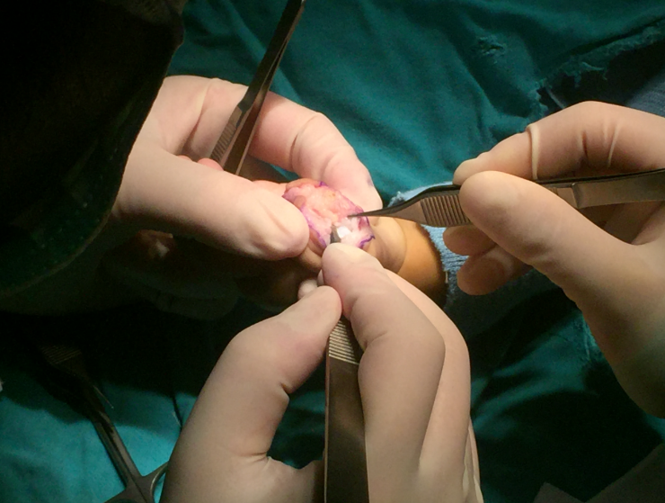 儿童包茎通常和年龄,先天发育问题或者后天疾病有关