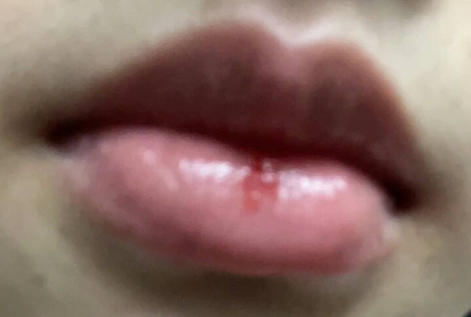 被猫抓破嘴唇出血了需要打狂犬疫苗吗?