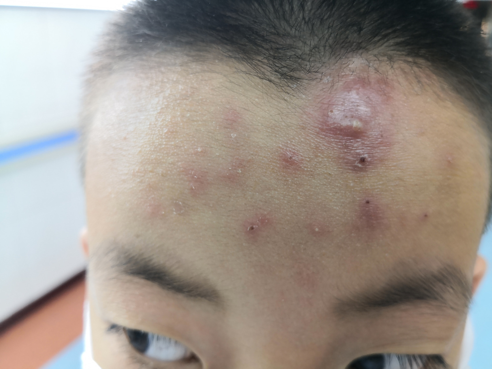 十岁的小男孩额头痤疮症状.